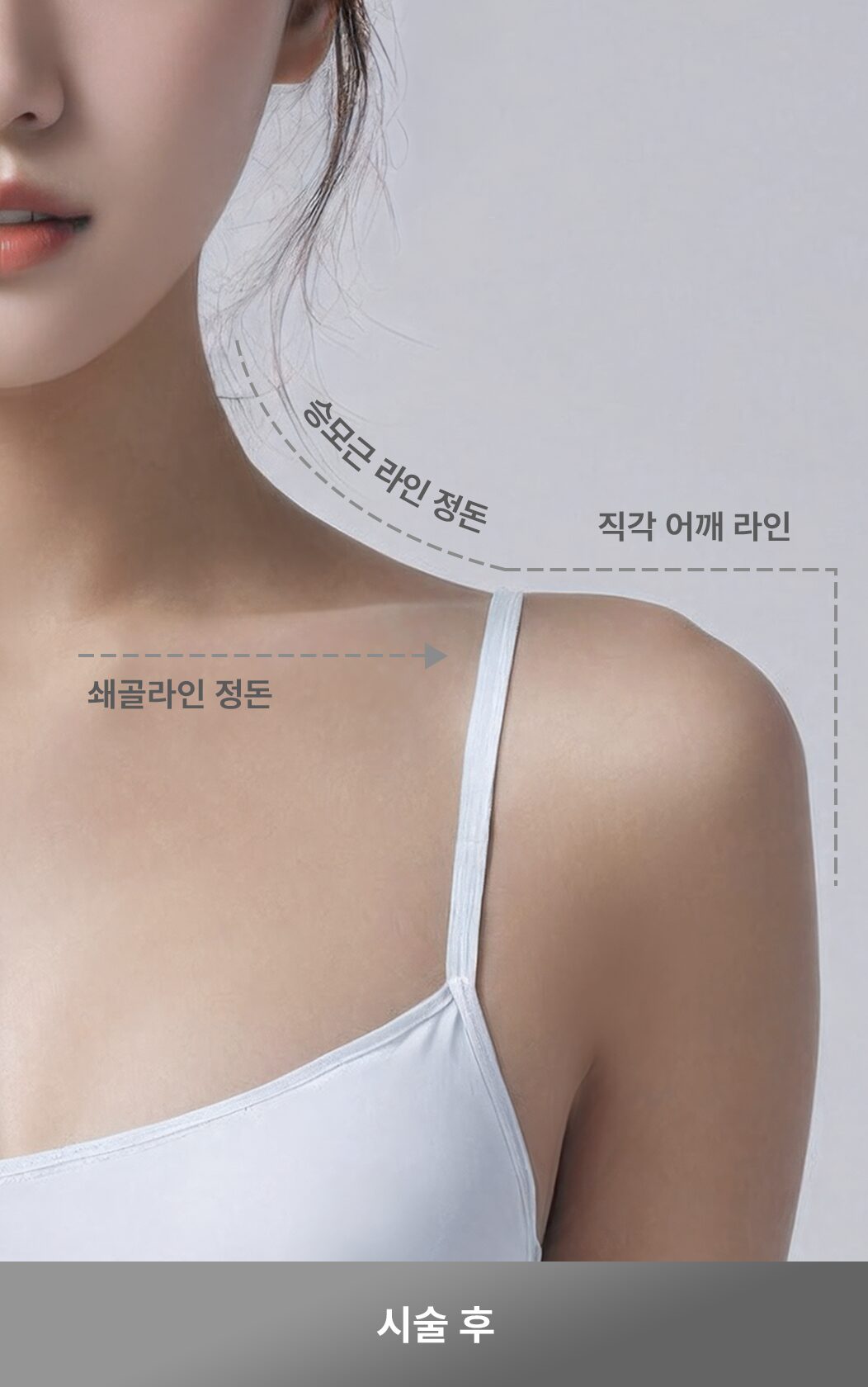 시술후